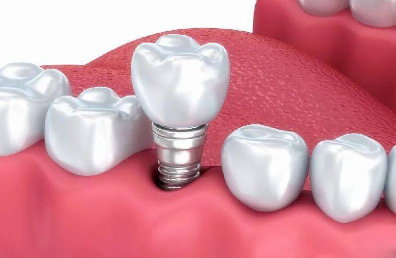 牙齿修复是什么修复方式有哪些