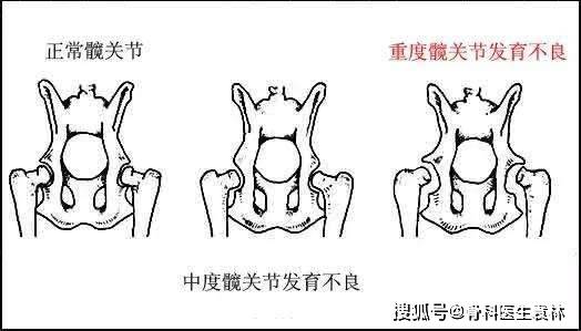 髋关节发育不良对身体有什么影响