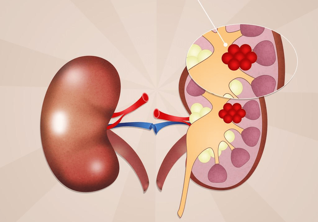 肾脏有癌,要守住6道"防线",尿毒症或可"绕路走"