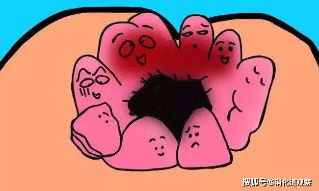 翻花痔——"菊花"绽放时刻