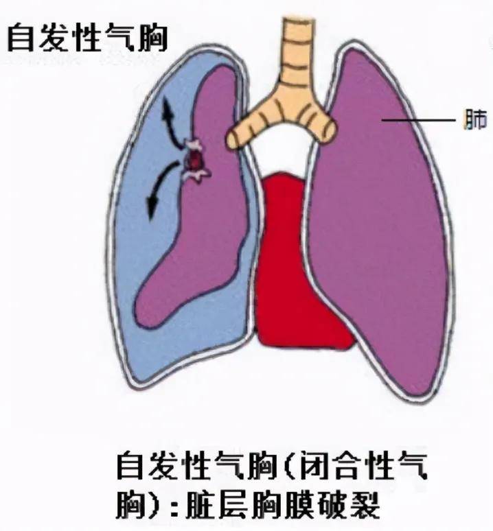 "那么,肺真的会"气炸"吗?