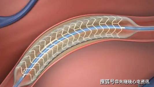 心脏支架进口国产怎么选?