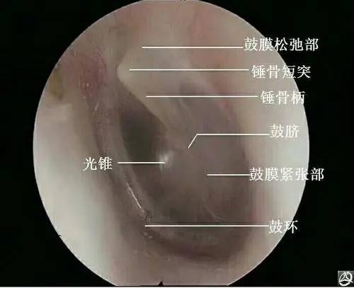 跟您聊一聊:我的鼓膜穿孔了,需要立即手术修补吗?