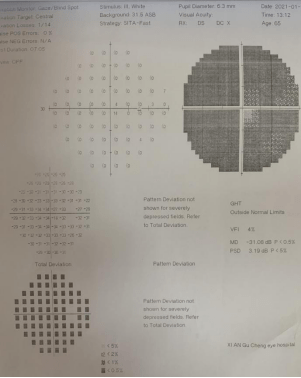 患者右眼在青光眼检查中的管状视野