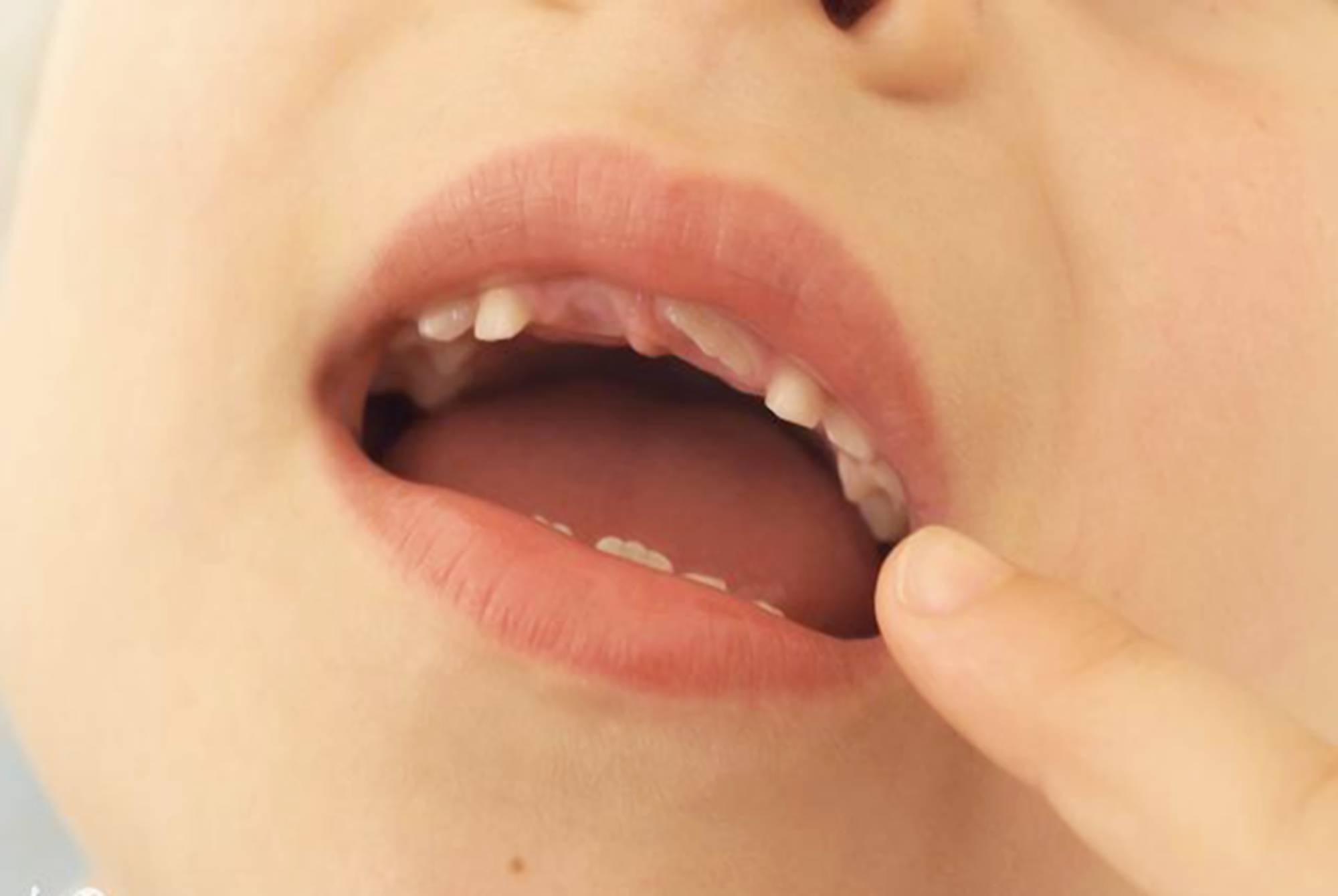宝宝5,6岁的时候乳牙会逐步脱落,取而代之的是恒牙,第二组牙齿会伴随
