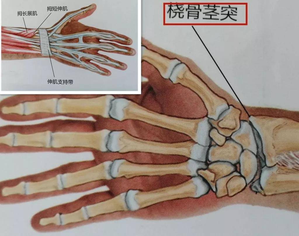 手腕疼痛,活动受限,6种方法应对"节后腱鞘炎"_桡骨