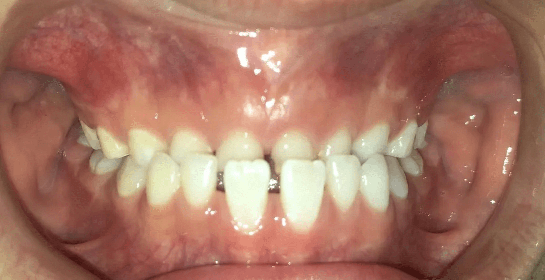 12岁前必须处理的10种儿童牙颌畸形!