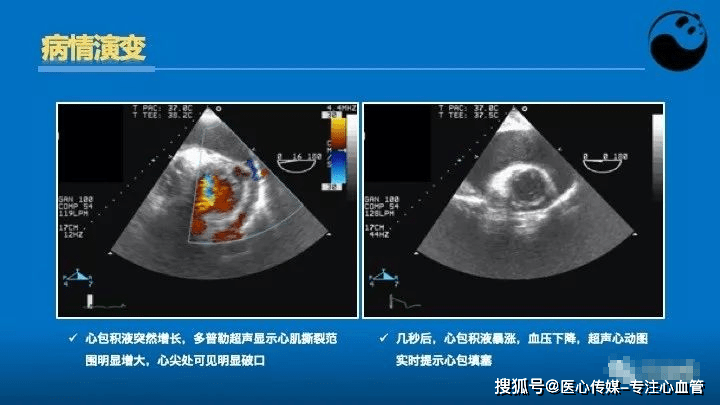 心脏介入医生应该掌握的超声心动图知识_检查