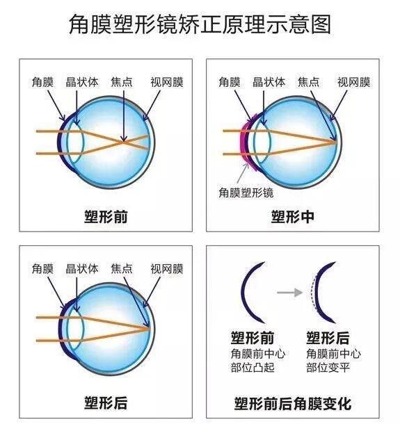 一,角膜塑形镜是什么?