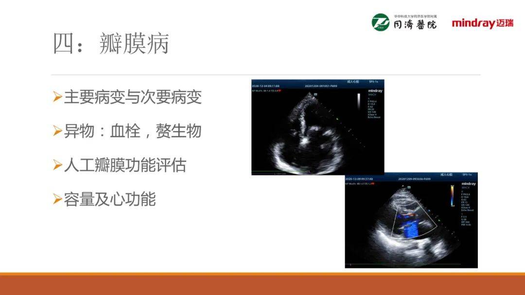 围术期经胸超声心动图(tte)