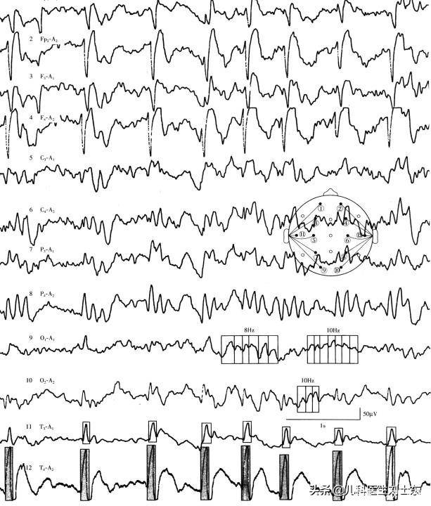 小儿脑电图判读精述