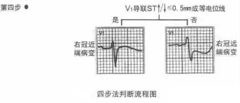 ②高侧壁