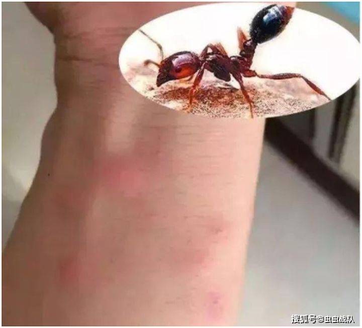 然后再伤口周围轻轻按压,能将蚂蚁留下的蚁酸挤压出来,这样被咬后产生