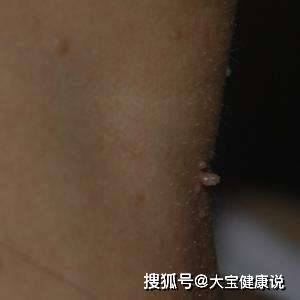 (二)肉疙瘩汗管瘤虽是肿瘤的一种,但仅是和雌性激素密切有关的良性