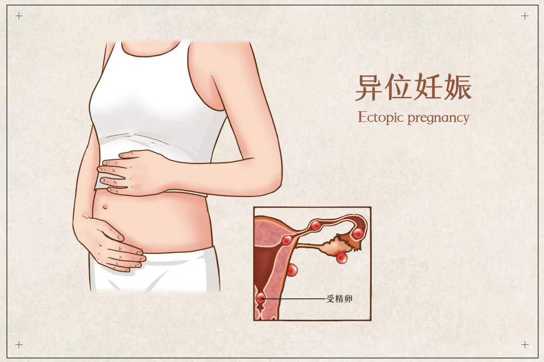 注意!女性肚子疼别再大意,一定要警惕!