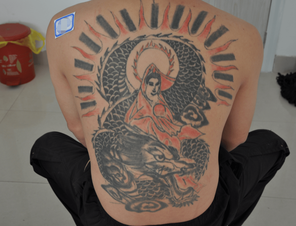 济南胎记血管瘤医院:纹身可以用药水清洗吗?