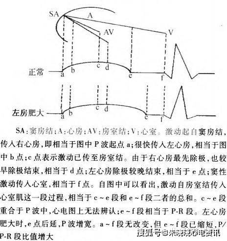 全面解读心脏肥大心电图诊断