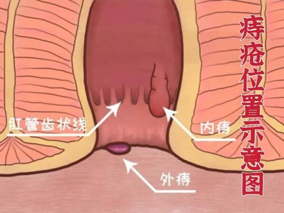 痔疮5步走,肉球,便血,坠胀不怕,15天看得见!