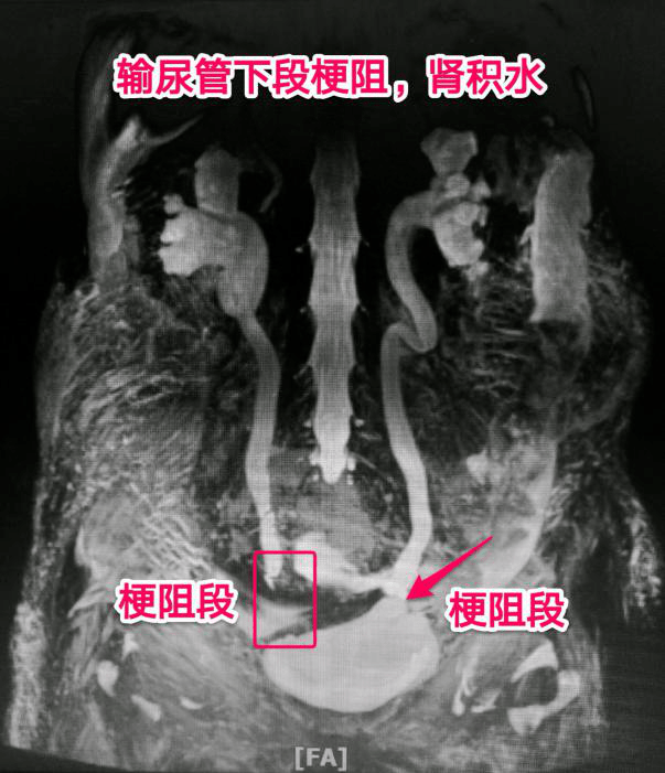 西安市中医医院多学科协作完成首例经皮肾输尿管支架管置入术