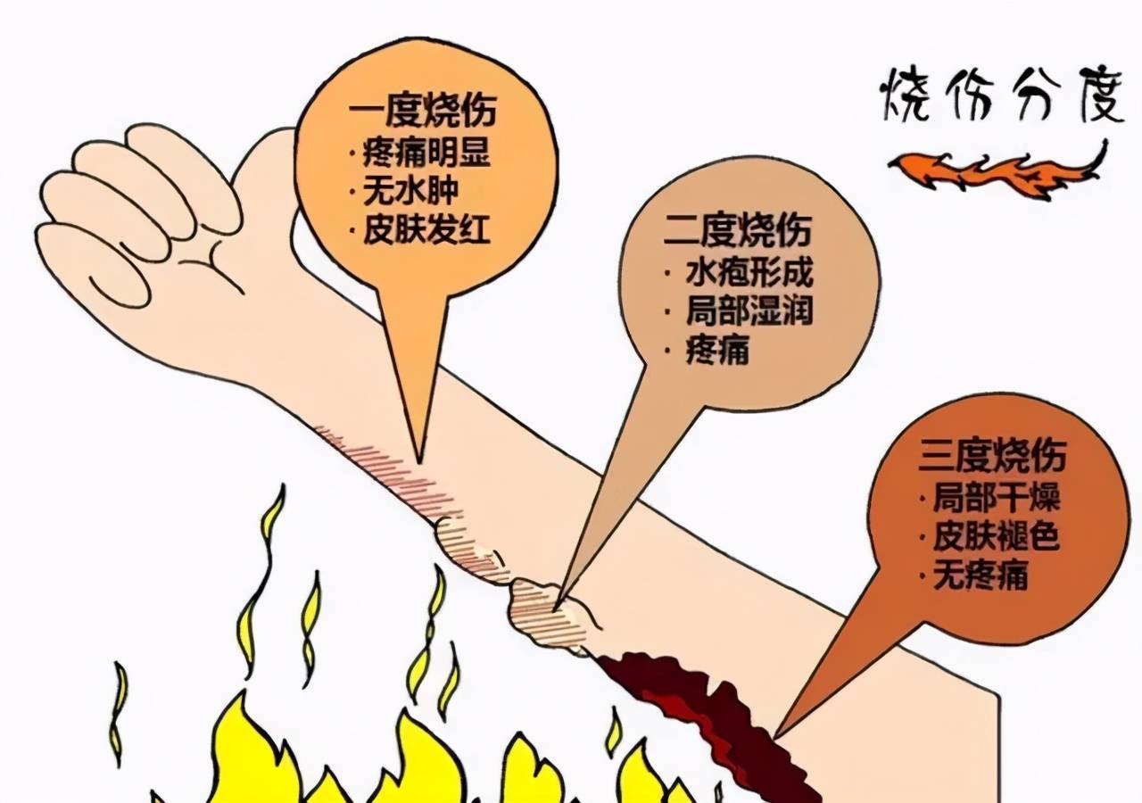 急救丨烫伤