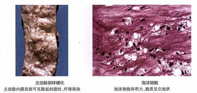 3,粥样斑块,也叫粥瘤 由纤维斑块深层细胞的坏死发展而来,是动脉粥样