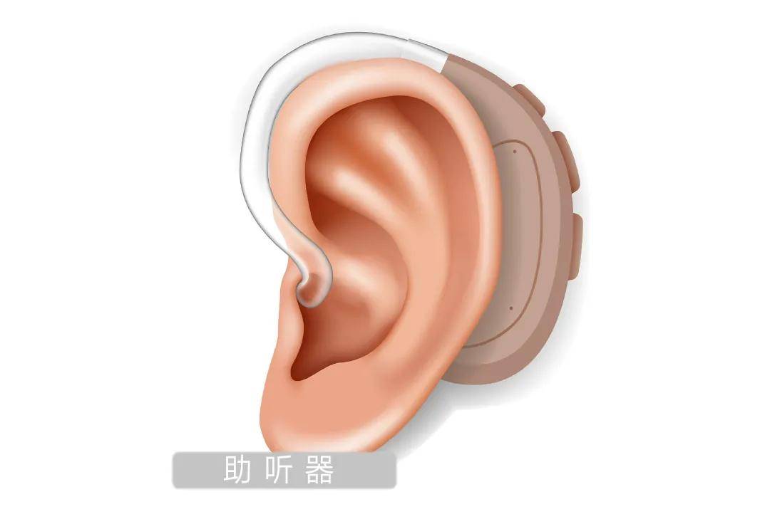 【人工耳蜗科普系列】人工耳蜗与助听器有什么区别,听听专家怎么说