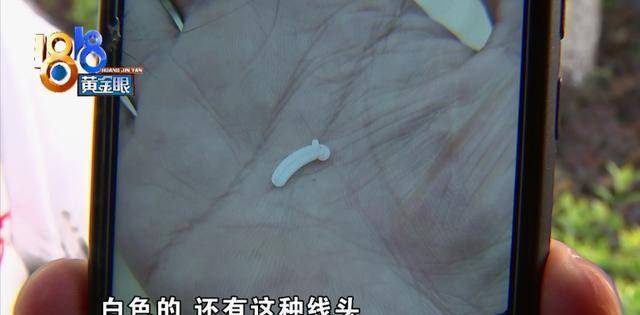 阑尾手术创口发炎,脓疱里挤出夹子?