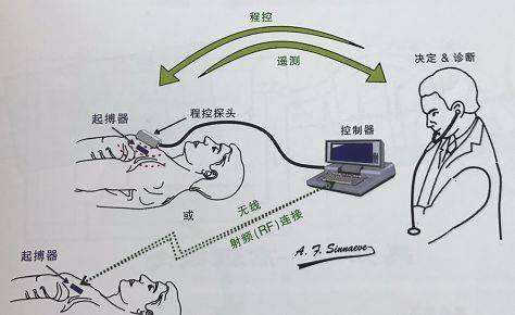 护心"神器"知多少—起搏器_心脏