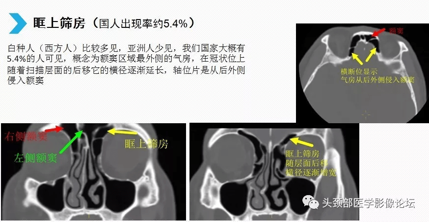 影像解剖 | 额筛气房与钩突附着部精细解剖_额窦