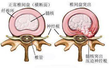 检查是腰椎间盘突出为什么腰不疼腿疼?