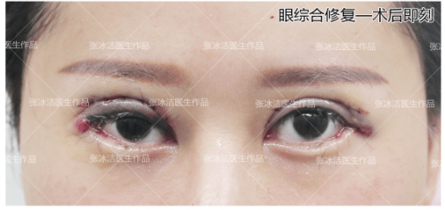 张冰洁院长谈【外眼角修复】——外眼角疤痕粘连修复!