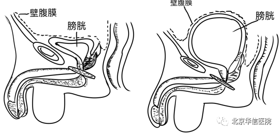 膀胱是储存尿液的肌性囊状器官,其形状,大小,位置和壁的厚度随尿液