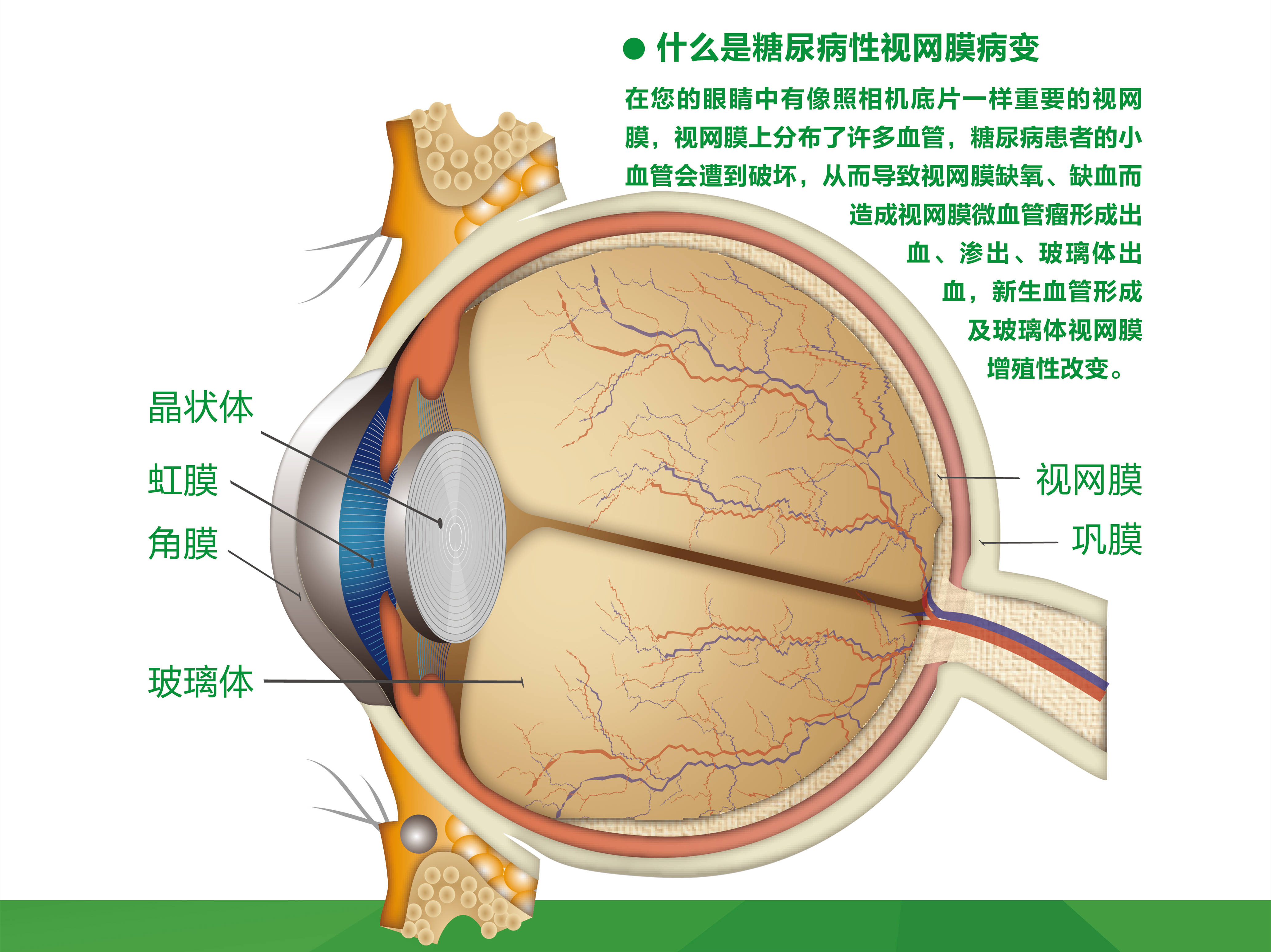 并发糖尿病视网膜病变者占51%,目前这一病变在致盲性眼病中排行第二