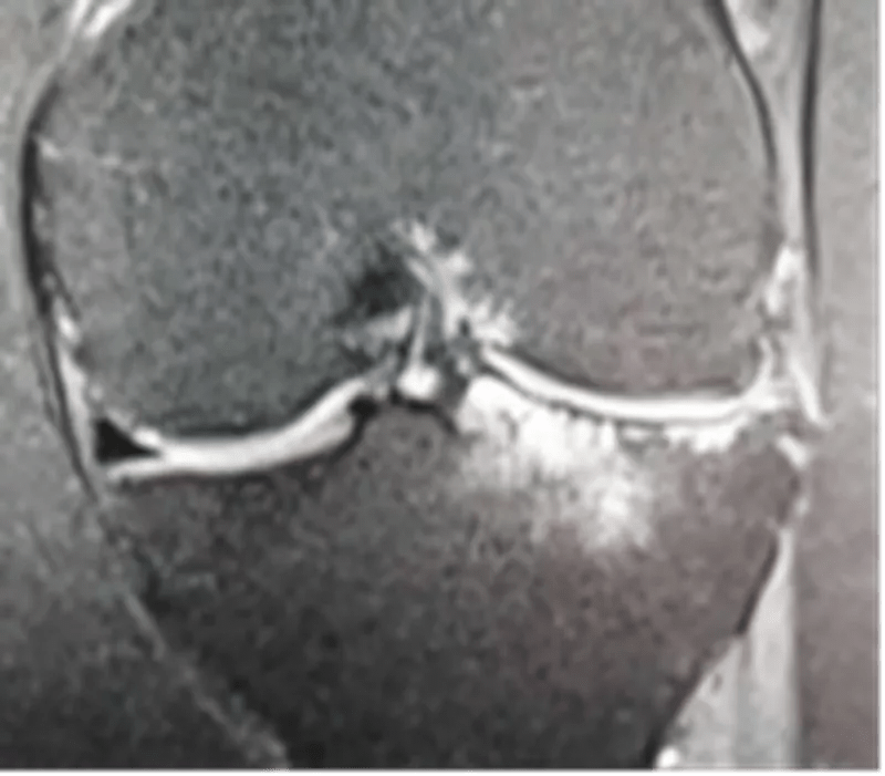 混合性撕裂外周边缘撕裂半月板-关节囊撕裂mri 诊断半月板撕裂的准确