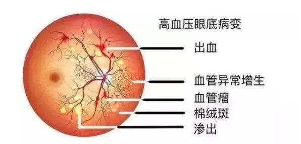 高血压性视网膜病变是怎么一回事