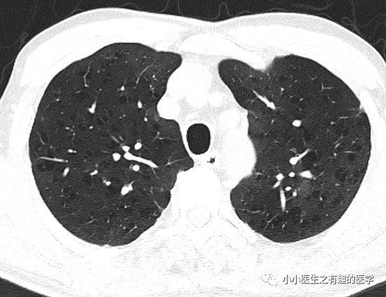 ct经典图谱:肺气肿ct典型图谱,一学就会