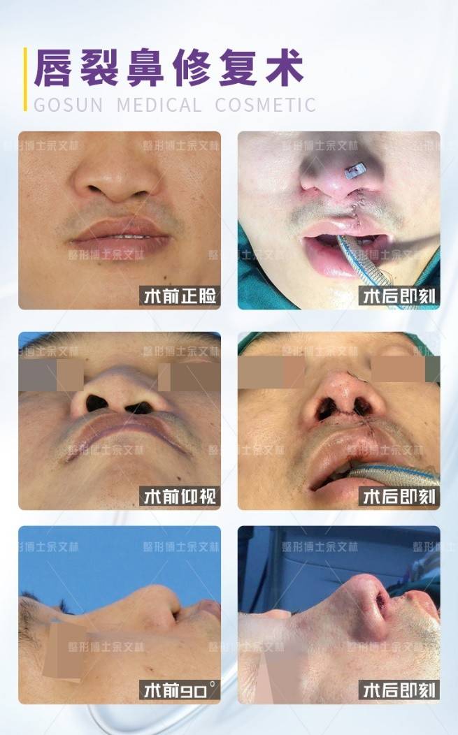 单侧唇裂修复术后的瘢痕修复与红唇修复