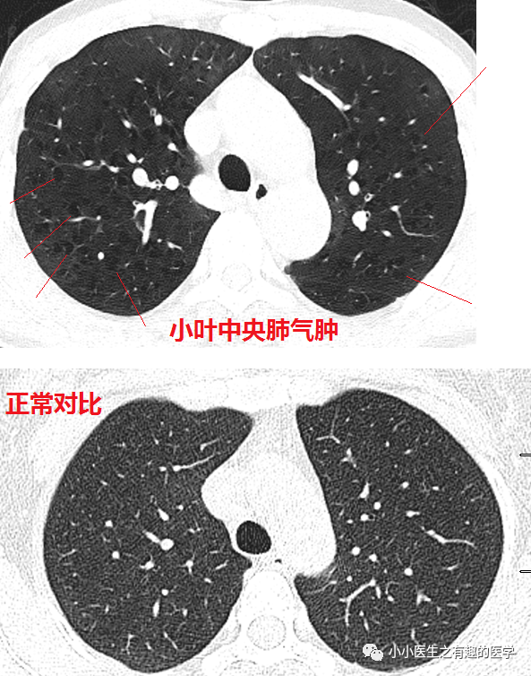 ct经典图谱:肺气肿ct典型图谱,一学就会