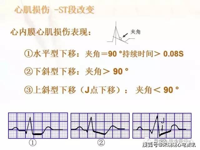 心肌缺血和心肌梗死的心电图改变ppt