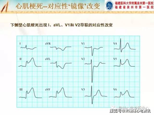 心肌缺血和心肌梗死的心电图改变ppt