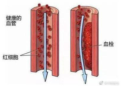 为什么你的血管会堵住?教你几招远离动静脉血栓!