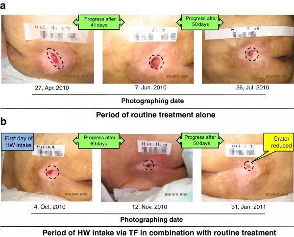 饮用氢水治疗褥疮的临床研究