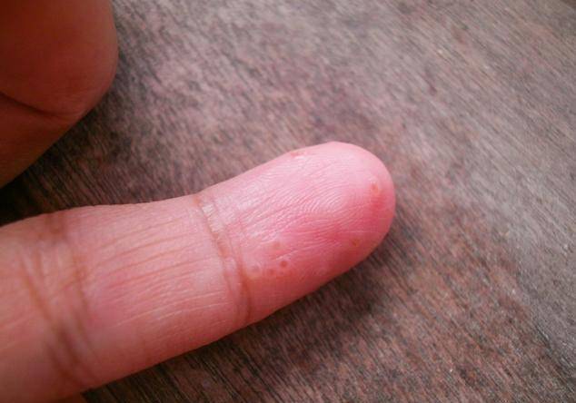 汗疱疹的发作常从瘙痒开始,随后在手掌,手指侧面,手指背面突发对刺痒