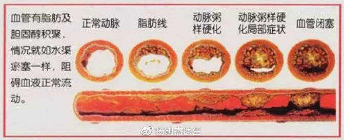 导致动脉硬化的原因有哪些?这几个因素可能是你常忽略