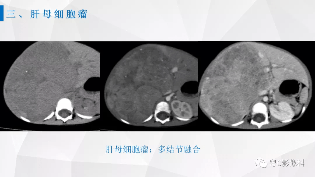 肝脏ct/mri增强扫描"快进快退"的诊断思路