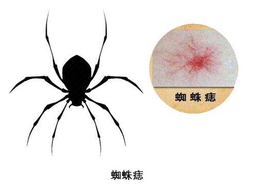 肝硬化有什么预兆性症状?医生:若身体出现四种"异常"