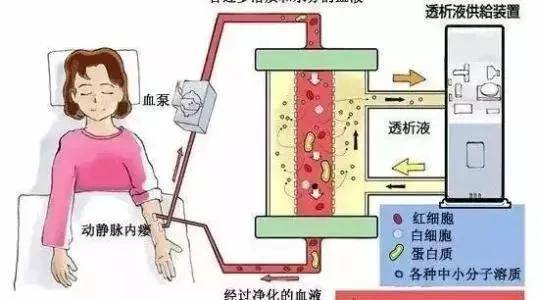 血液净化新技术血浆置换