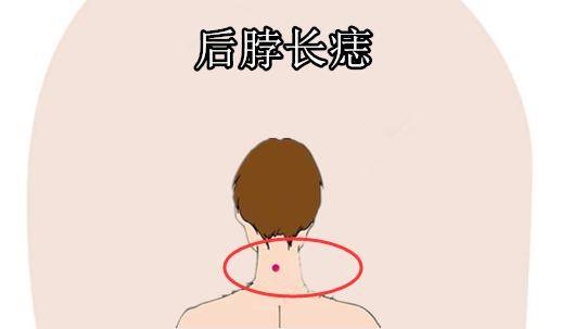 后脖长痣在相学当中,若是在后脖的位置处长有吉痣,尤其是在脖子后边
