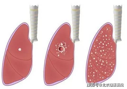 肺结节离肺癌到底有多远?
