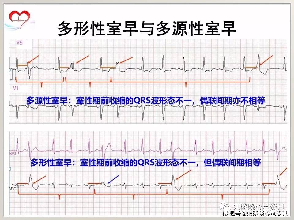 室性早搏的诊断与治疗ppt